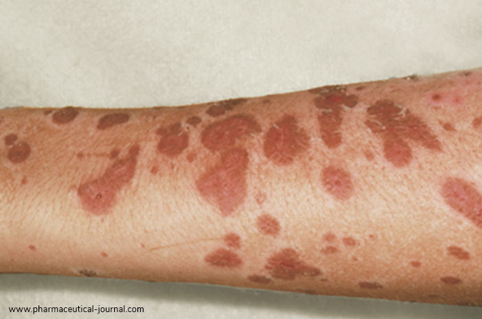Розпізнати синдром Стівенса Джонсона, який може спровокувати шкірні інфекції