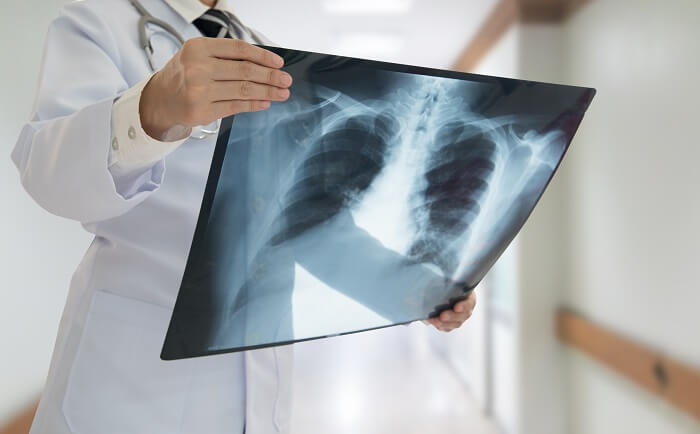 4 dolog, amit tudnod kell a tüdőröntgen elkészítése előtt