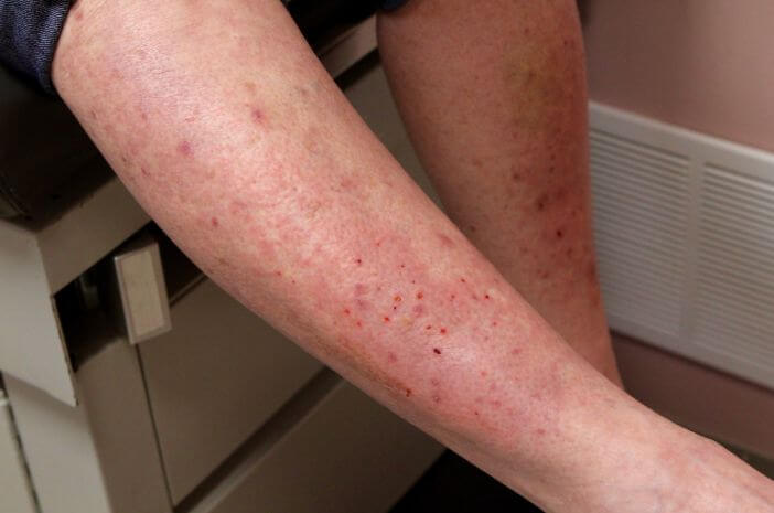 Brennen und Blasen der Haut, das sind Symptome von Dermatitis Herpetiformis