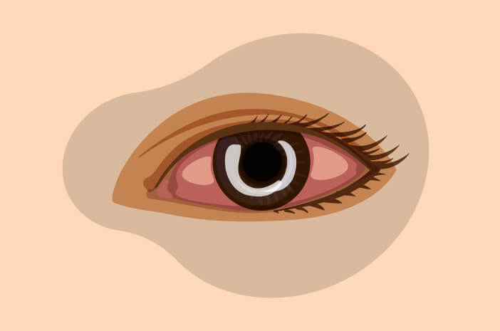 Weiße Flecken auf den Augen, Vorsicht vor Hornhautgeschwüren