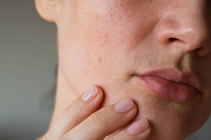 Hypoparathyreoïdie kan een droge, schilferige huid veroorzaken?