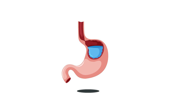 Які характеристики підвищення кислотності шлунка?