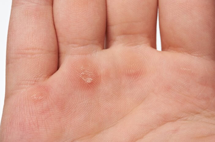 5 דרכים להיפטר מיבלות בכפות הידיים