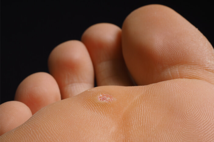 4 veel voorkomende huidziekten die op de voeten verschijnen