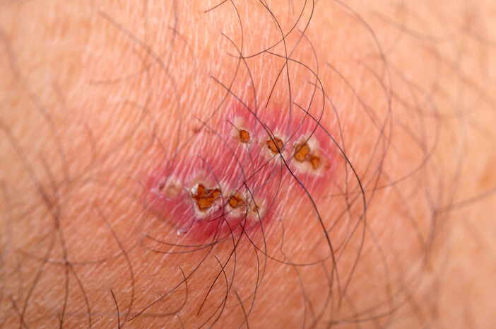 למידע נוסף על אימפטיגו, זיהום עור חיידקי
