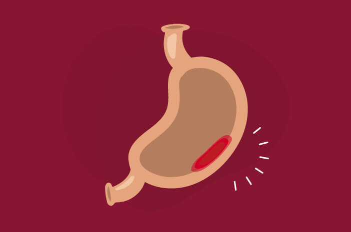 Caractéristiques de l'ulcère d'estomac qui le distinguent de la gastrite
