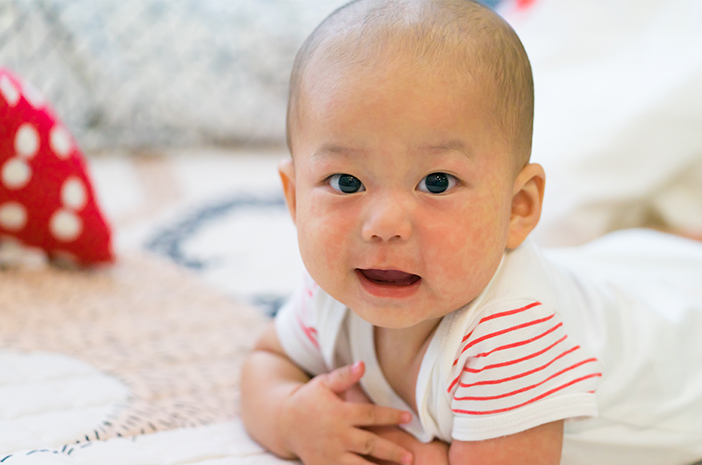 5 sposobów na pokonanie czerwonych plam na skórze dziecka