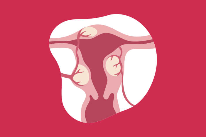 Sind Uterusmyome eine gefährliche Erkrankung?