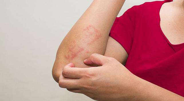 Eczema, o boală cronică de piele care tulbură aspectul