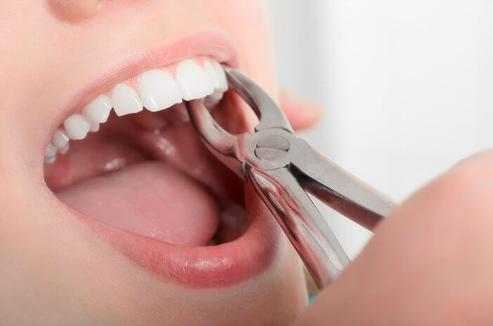3 осложнения, которые могут возникнуть при удалении зуба мудрости