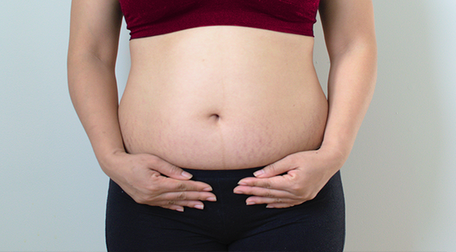 9 tips för att bli av med bristningar efter graviditet