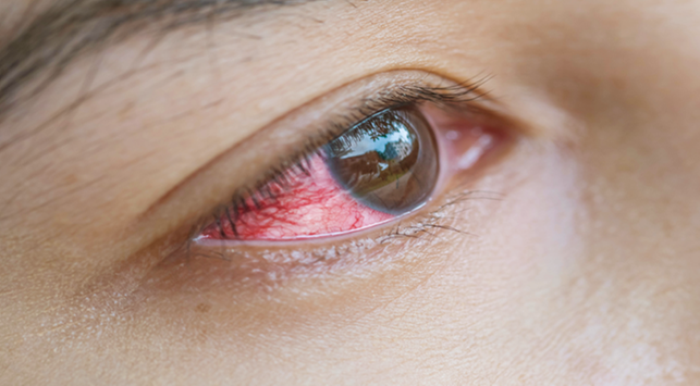 6 zagrożeń związanych z bólem oka z powodu Sofles