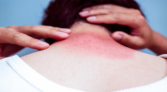 6 natuurlijke manieren om een ​​door de zon verbrande huid te overwinnen