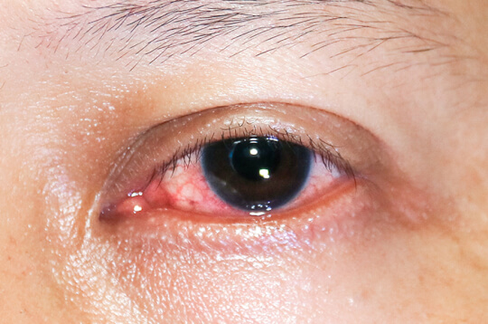 눈을 공격할 수 있는 염증의 4가지 유형 알아보기