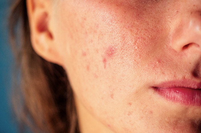 10 síntomas de lupus en mujeres que necesita saber