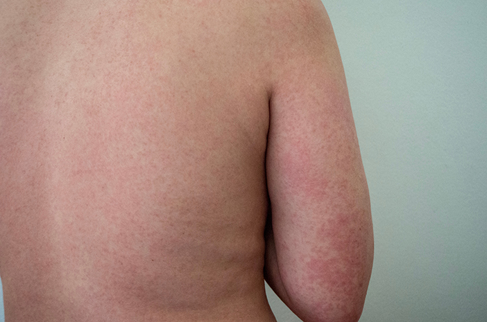 Mit ili činjenica, alergije na pelud mogu uzrokovati koprivnjaču