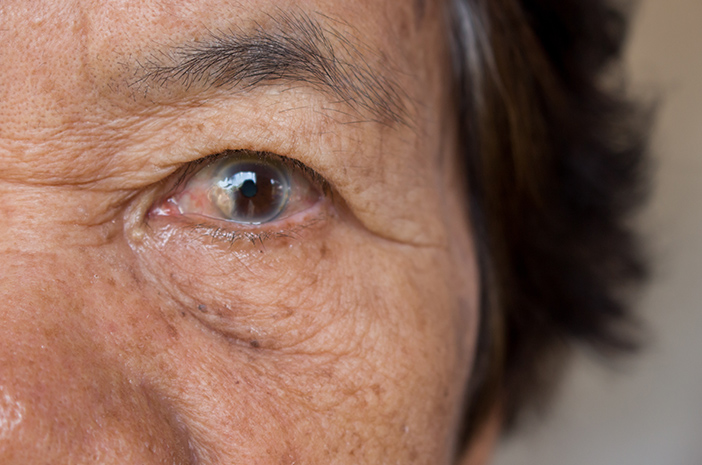 Choroba zaćmy starczej może wywołać jaskrę