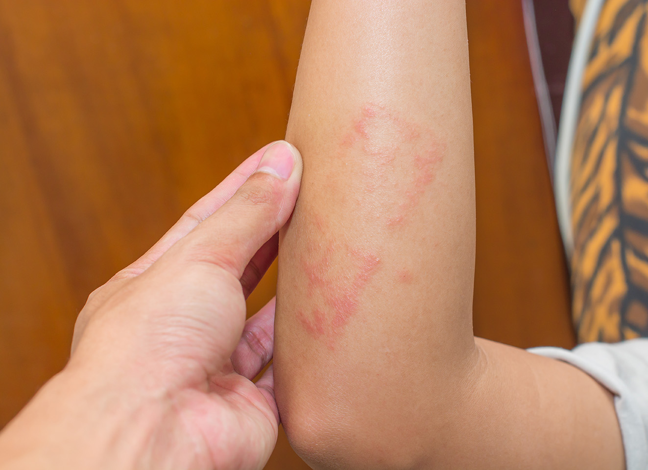 Az ótvaros bőr gombás fertőzésének típusai