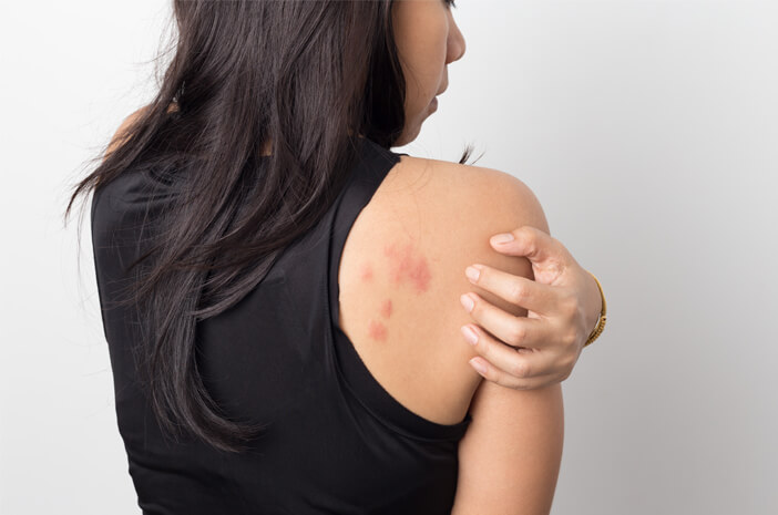 Hautausschlag kann auch ein Symptom von Typhus sein