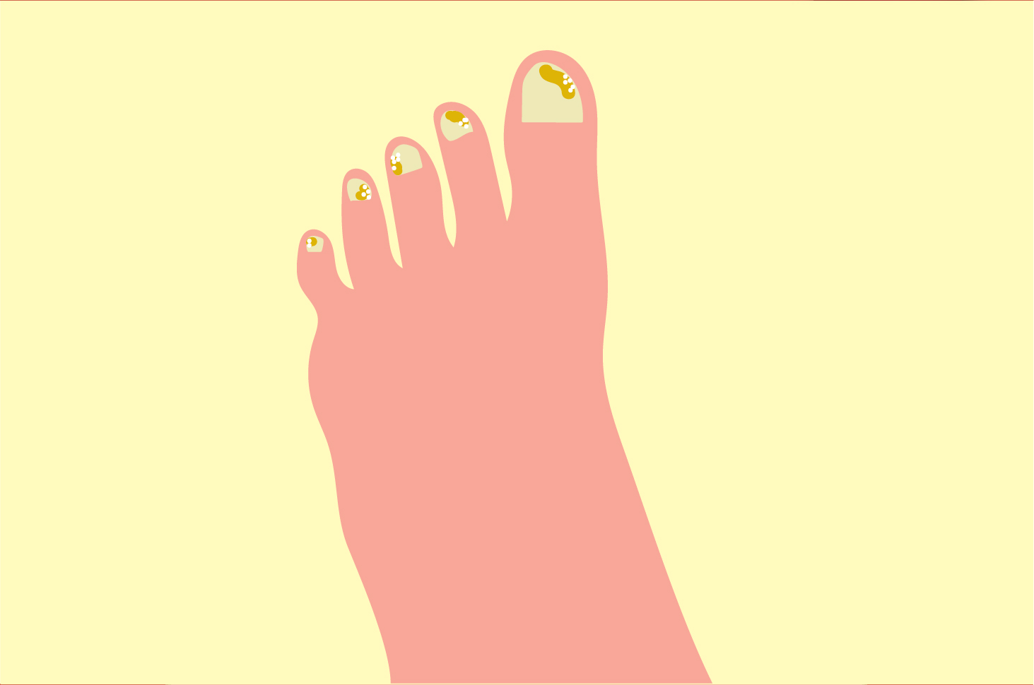 10 речей, які можуть викликати грибок нігтів на ногах