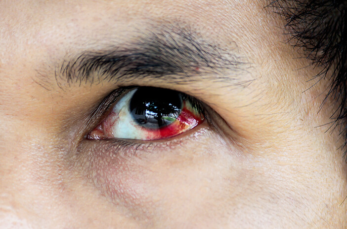 5 causas de manchas rojas en los ojos