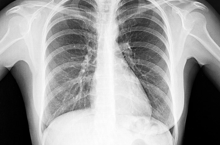 Знайте ознаки поширення COVID-19 у легенях
