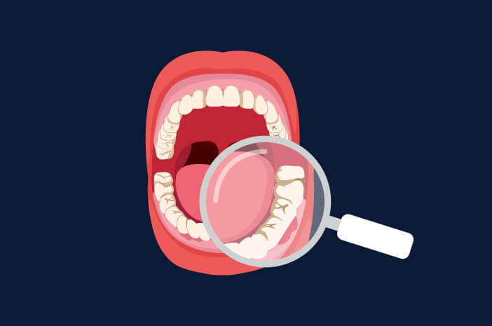 4 речі, які трапляються, якщо зубний камінь не очищати