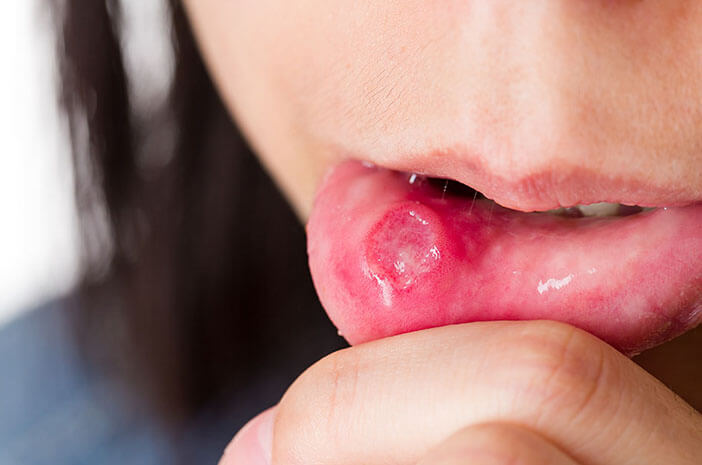 Nicht irren, hier ist, wie man den Unterschied zwischen gewöhnlicher Soor und Symptomen von Mundkrebs erkennt