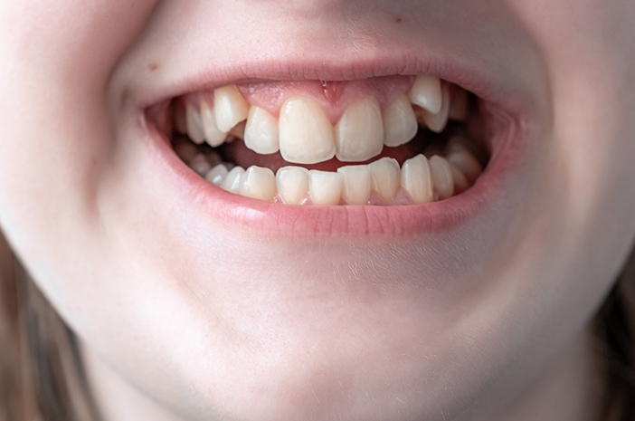 4 érdekes tény a Ginsul fogakról