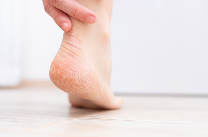 Comment traiter la peau craquelée des pieds