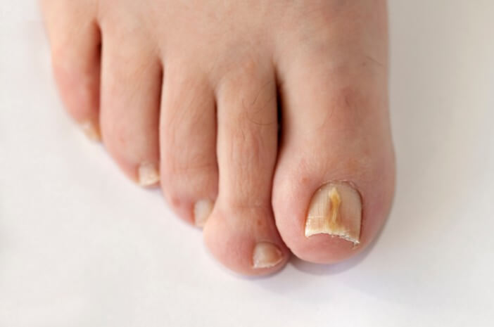 Збентежені пошкоджені нігті на ногах через грибок нігтів? Ось як це вилікувати